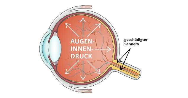 Glaukombehandlung Dr Curschmann Augenzentrum